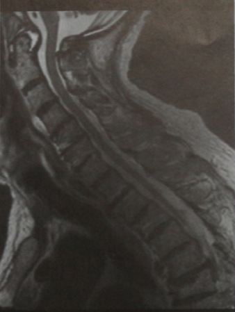 Снимки МРТ и КТ. Ревматоидный артрит хроническая травма