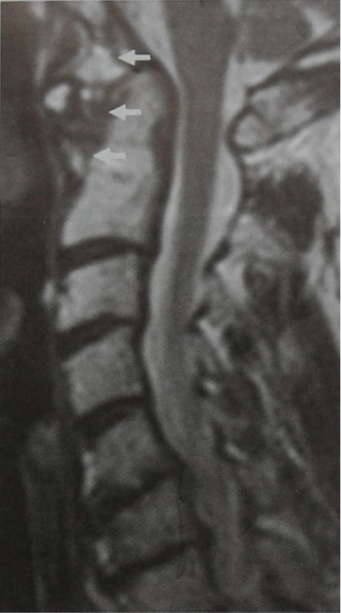 Снимки МРТ и КТ. Ревматоидный артрит