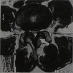 Снимки МРТ и КТ. Гипертрофия желтых связок