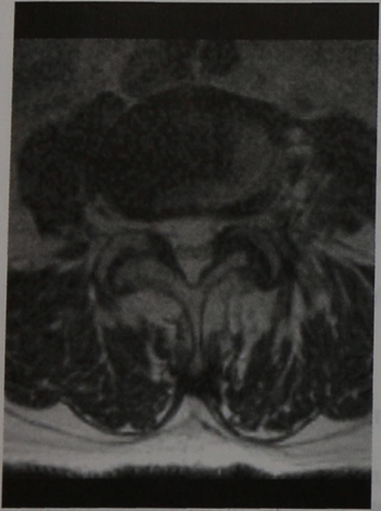 Снимки МРТ и КТ. Грыжа диска