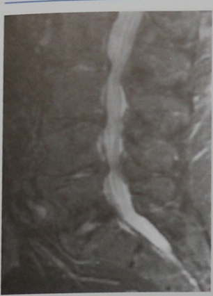 Снимки МРТ и КТ. Дегенеративный стеноз позвоночного канала 