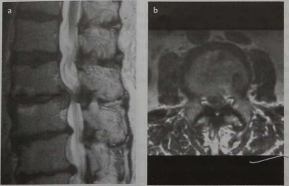 Снимки МРТ и КТ. Дегенеративный стеноз позвоночного канала 