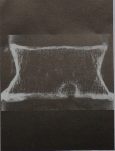 Снимки МРТ и КТ. Дегенерация межпозвоночных дисков