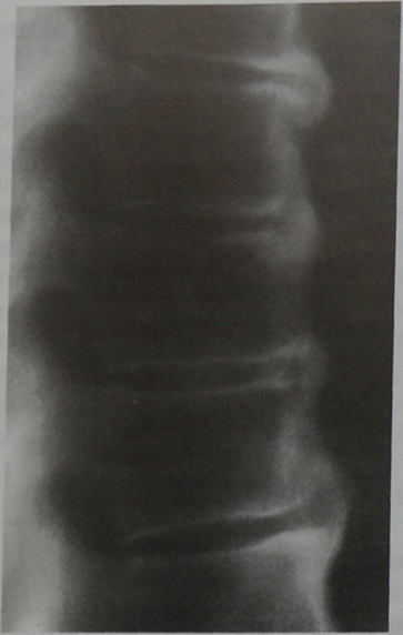 Снимки МРТ и КТ. Диффузный идиопатический скелетный гиперостоз