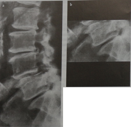 Снимки МРТ и КТ. Обызвествление межпозвоночных дисков