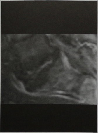 Снимки МРТ и КТ. Вторая стадия остеохондроза