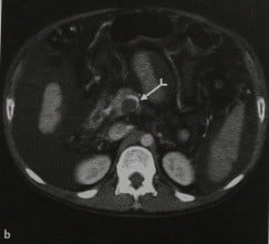 Снимки МРТ и КТ. Тромбозы брыжеечных и воротной вен