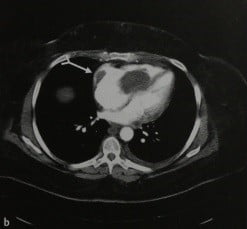 Снимки МРТ и КТ. Тромбоз нижней полой вены