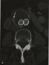 Снимки МРТ и КТ. Эндоваскулярные затеки после стентирования аорты