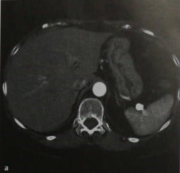 Снимки МРТ и КТ. Аневризмы висцеральных артерий 