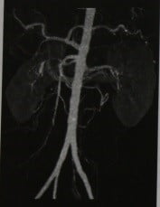 Снимки МРТ и КТ. Васкулиты с поражением брыжеечных артерий