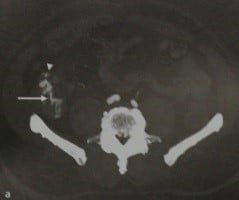 Снимки МРТ и КТ. Желудочно-кишечное кровотечение