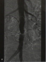 Снимки МРТ и КТ. Хроническое окклюзионное поражение аорты