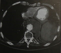 Снимки МРТ и КТ. Разрыв аневризмы грудного отдела аорты