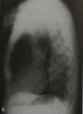 Снимки МРТ и КТ. Аневризма грудного отдела аорты