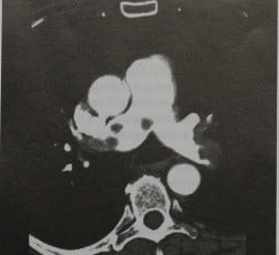 Снимки МРТ и КТ. Эмболия легочной вены 