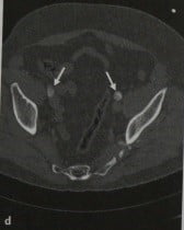 Снимки МРТ и КТ. Расслоение аорты