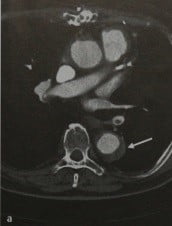Снимки МРТ и КТ. Интрамуральная гематома аорты