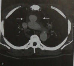 Снимки МРТ и КТ. Инфекционная (микотическая) аневризма