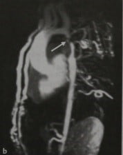 Снимки МРТ и КТ. Коарктация аорты