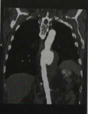 Снимки МРТ и КТ. Острый аортальный синдром 