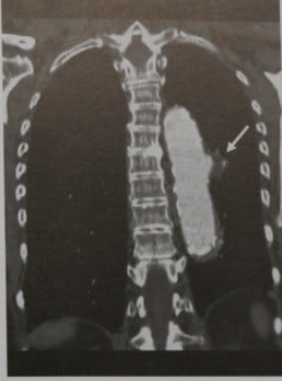 Снимки МРТ и КТ. Пенетрирующая язва аорты