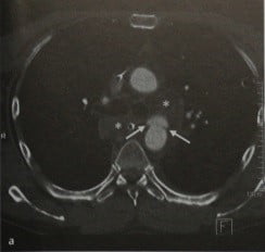 Снимки МРТ и КТ. Травматический разрыв аорты