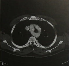 Снимки МРТ и КТ. Удвоение дуги аорты