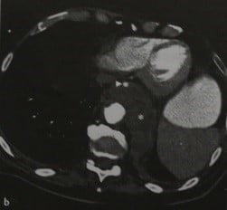 Снимки МРТ и КТ. Разрыв аневризмы грудного отдела аорты