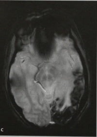 Снимки МРТ и КТ. Синдром Стерджа-Вебера