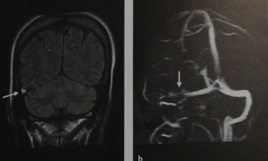 Снимки МРТ и КТ. Тромбоз венозных синусов и вен головного мозга
