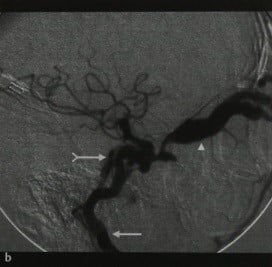 Снимки МРТ и КТ. Фистула сонной артерией и кавернозного синуса