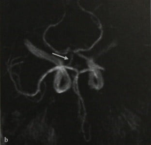 Снимки МРТ и КТ. Персистирующая тригеминальная артерия