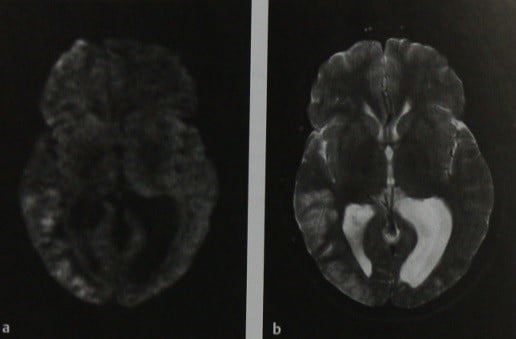 Снимки МРТ и КТ. Острый ишемический инсульт