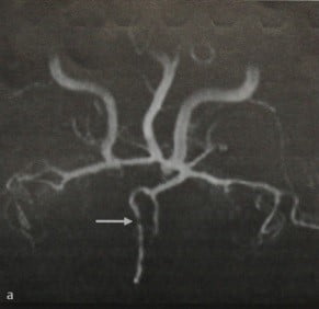 Снимки МРТ и КТ. Интракраниальный васкулит