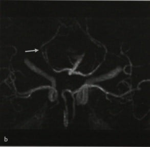 Снимки МРТ и КТ. Интракраниальный васкулит