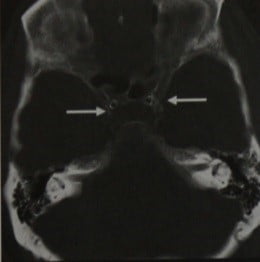 Снимки МРТ и КТ. Атеросклероз интракраниальных артерий