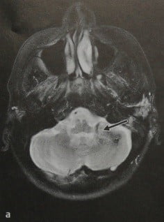 Снимки МРТ и КТ. Венозная ангиома