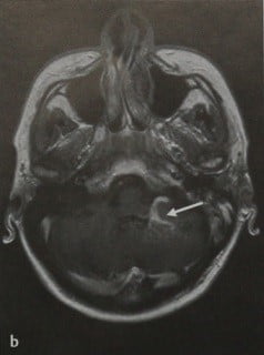 Снимки МРТ и КТ. Венозная ангиома