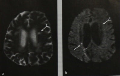 Снимки МРТ и КТ. Церебральная амилоидная ангиопатия