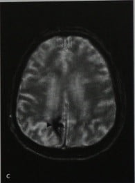 Снимки МРТ и КТ. Церебральная амилоидная ангиопатия