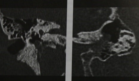 Снимки МРТ и КТ. Опухоль яремного гломуса 
