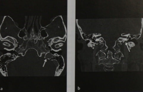 Снимки МРТ и КТ. Высокое расположение яремной луковицы