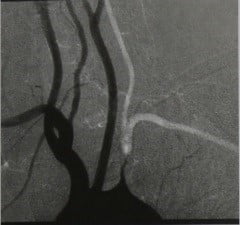 Снимки МРТ и КТ. Синдром обкрадывания подключичной артерии