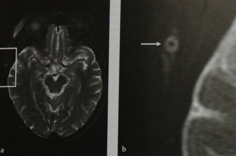 Снимки МРТ и КТ. Гигантоклеточный артериит 