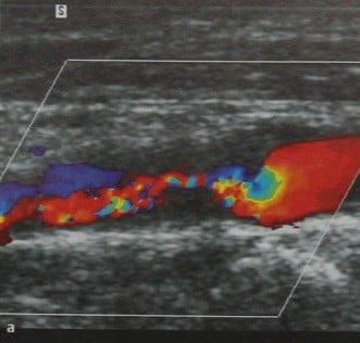 Снимки МРТ и КТ. Стеноз экстракраниального сегмента сонной артерии