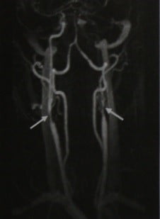 Снимки МРТ и КТ. Стеноз экстракраниального сегмента сонной артерии