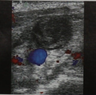 Снимки МРТ и КТ. Тромбоз яремной вены