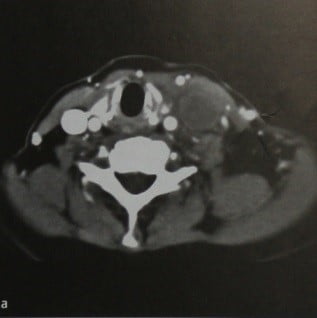 Снимки МРТ и КТ. Тромбоз яремной вены