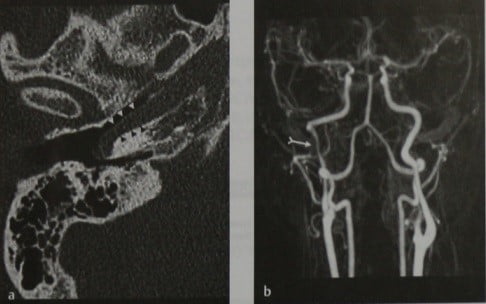 Снимки МРТ и КТ. Аберрантная внутренняя сонная артерия
